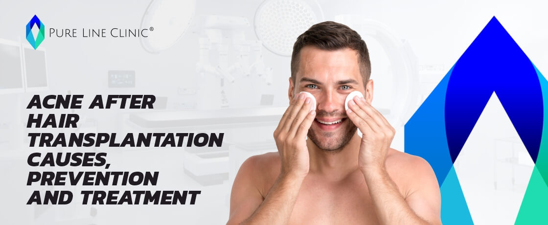 Acne After Hair Tranplantation Causes,Prevention and Treatment