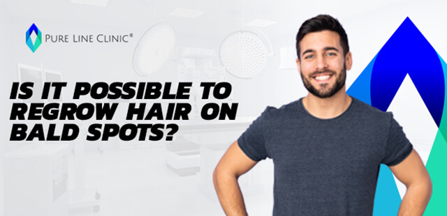 Is It Possible to Regrow Hair on Bald Spots? 