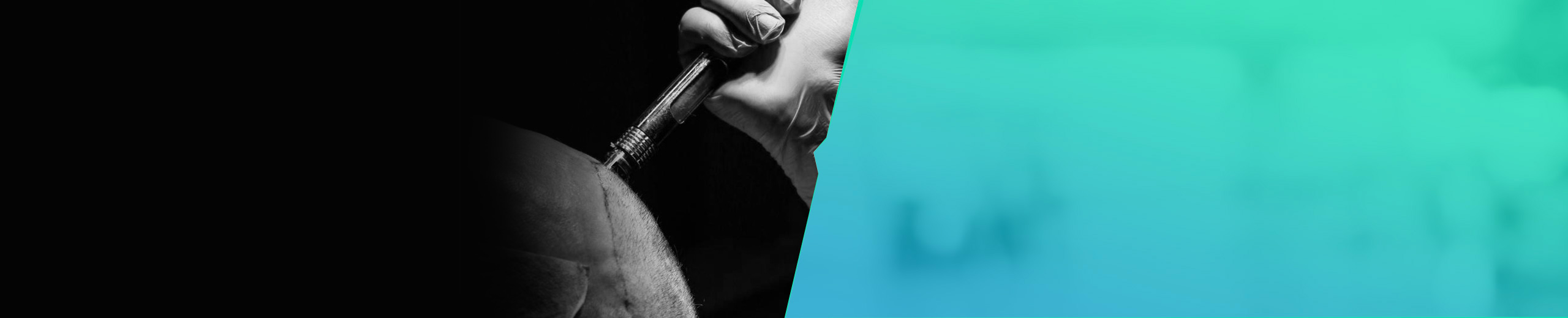 Less Pain Hair Transplant - PureSoft® Technique